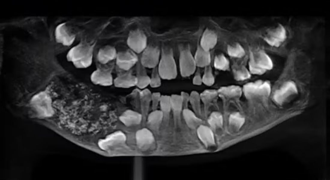 O caso do menino indiano que teve 526 dentes extraídos do maxilar chocou a comunidade médica mundial em 2019