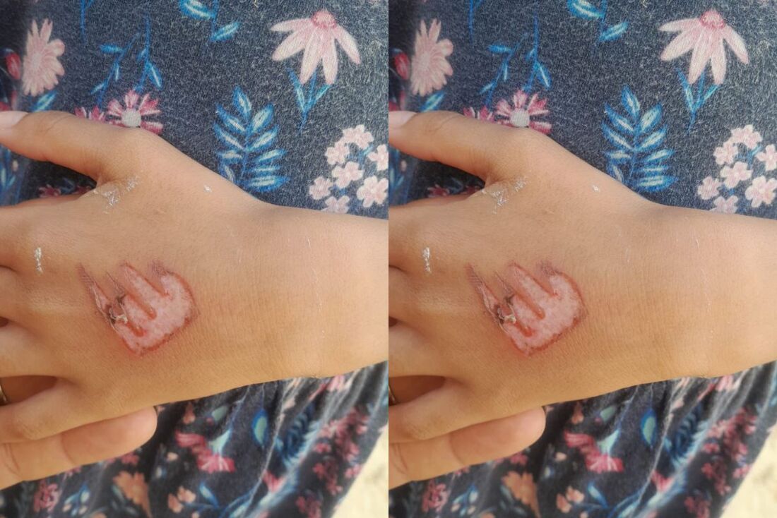 Mão da menina de sete anos queimada pela mãe