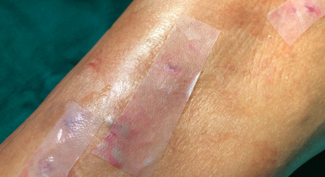 Curativo feito à base de cana-de-açúcar mostrou-se eficaz no comparativo com o material sintético