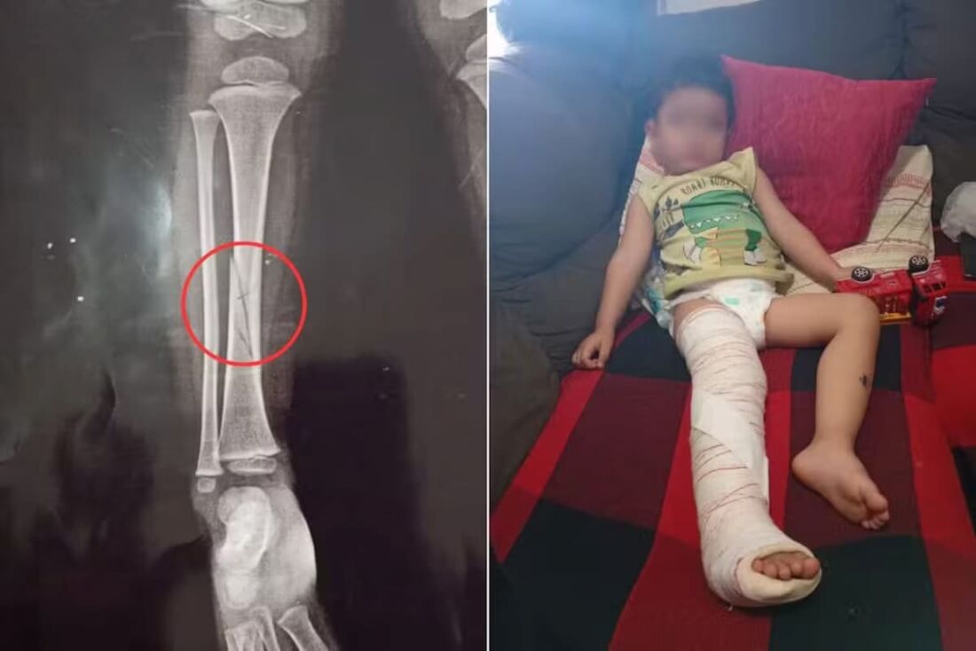 Ministério Público investiga incidente que deixou menino com perna quebrada em creche de SP.
