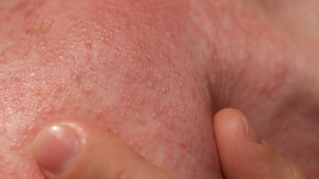 Doença pode causar óbito, a depender da gravidade e tratamento