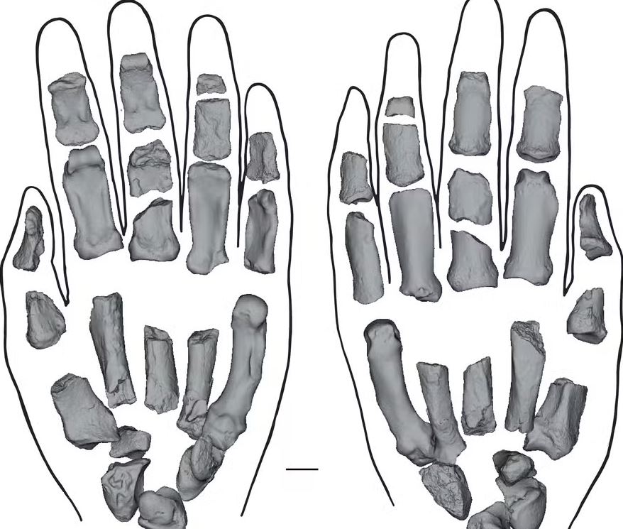 Imagens dos ossos encontrados das mãos direita e esquerda 