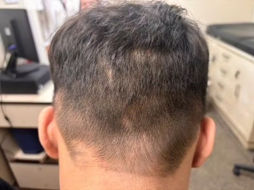 M.F.S., de 17 anos, teve seu primeiro corte de cabelo rente após se recuperar da alopecia causada por síndrome autoimune