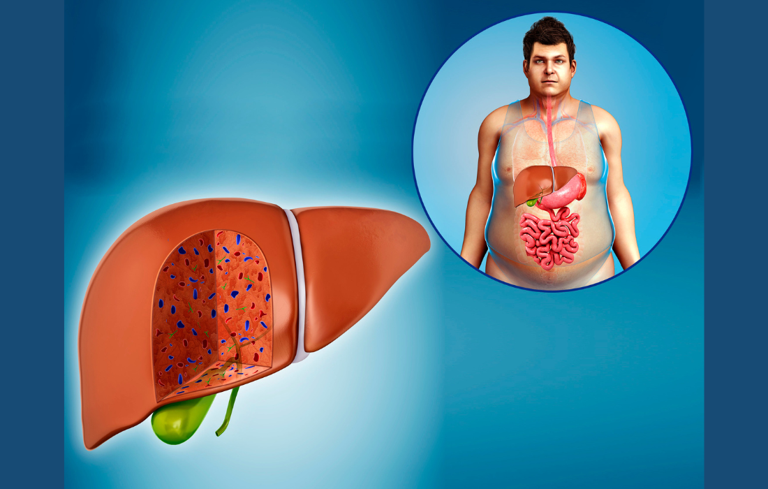 Gordura no fígado: exige prevenção com hábitos saudáveis