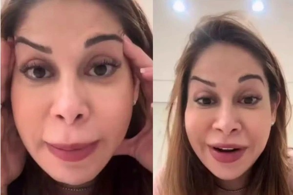 Maíra Cardi exibe rosto deformado após botox dar errado: 'Olha que palhaçada'