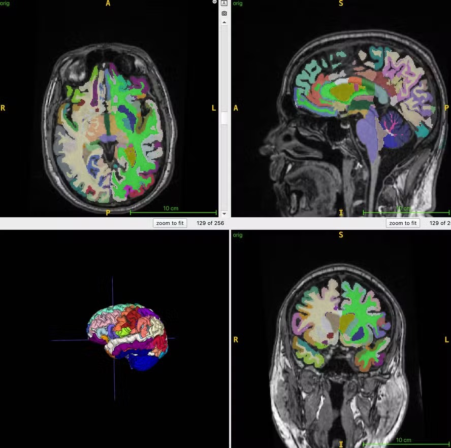 Imagens da figura do cérebro em cores na ressonância magnética usados para cálculos da idade cerebral 