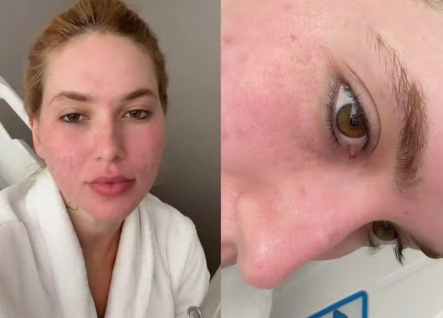 Virginia faz tratamento no rosto