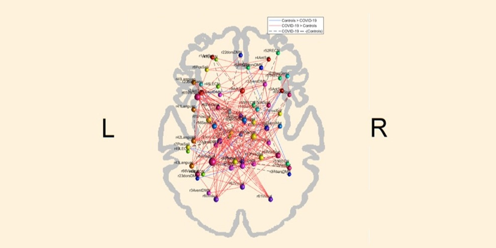 As linhas azuis na imagem representam as conexões que estão diminuídas nos voluntários que tiveram COVID-19 em comparação aos indivíduos do grupo controle. As linhas vermelhas correspondem às conexões que estão aumentadas nos participantes que foram infectados pelo SARS-CoV-2