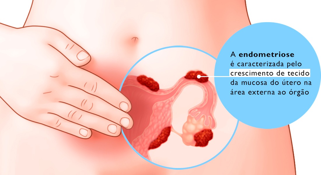 Endometriose