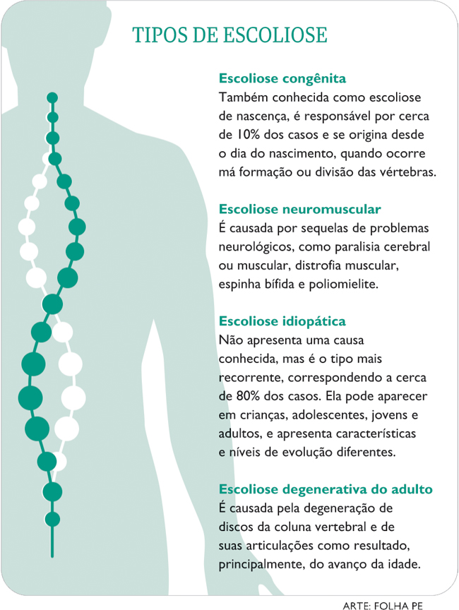 O que é escoliose? Veja sintomas e 4 exercícios posturais, saúde