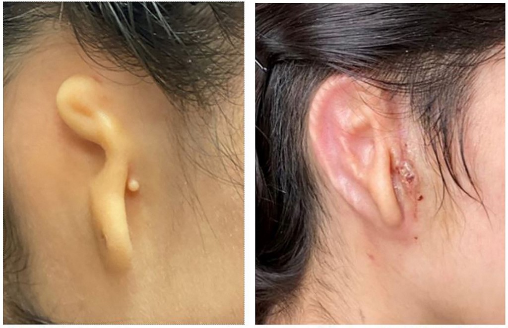 Antes e depois de 30 dias de cirurgia da orelha de um paciente que reconstruiu o lóbulo da orelha