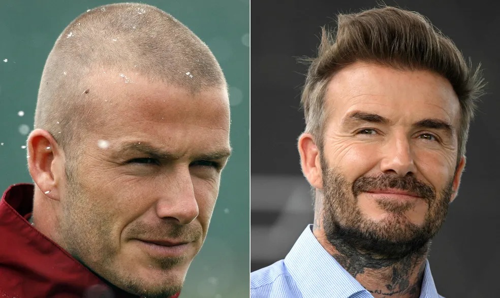 Beckham também realizou o procedimento 