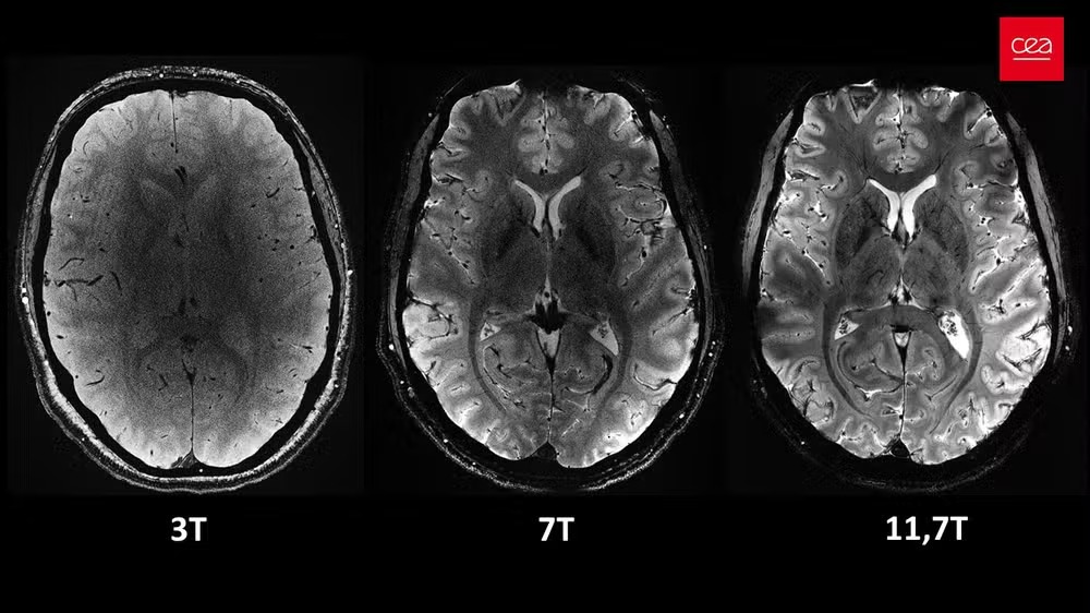 Vista axial do cérebro humano, com o mesmo tempo de aquisição, mas com diferentes intensidades de campo magnético. Na última, a imagem do Iseult Magneton 11.7 T MRI