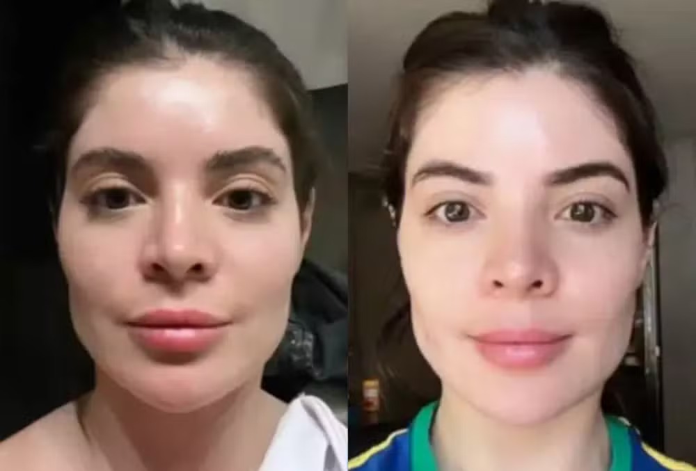 Gkay desfez harmonização facial 