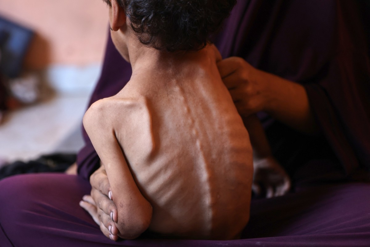 Fome na Faixa de Gaza