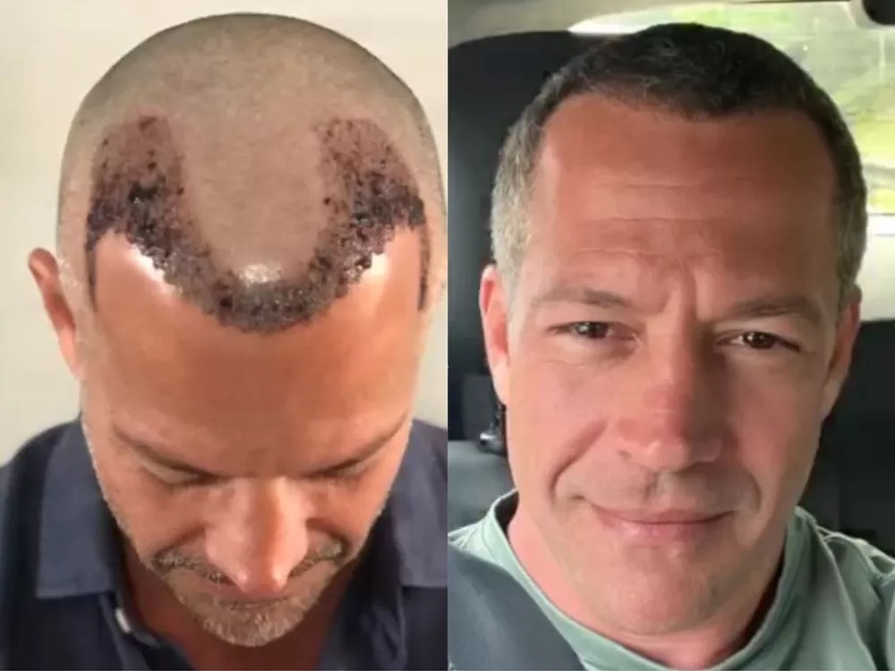 O ator Malvino Salvador mostra processo do transplante capilar 