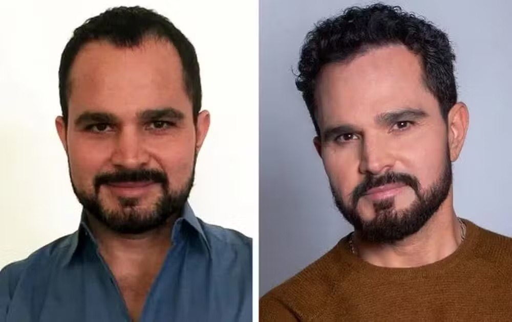 Luciano Camargo antes e depois do transplante capilar 