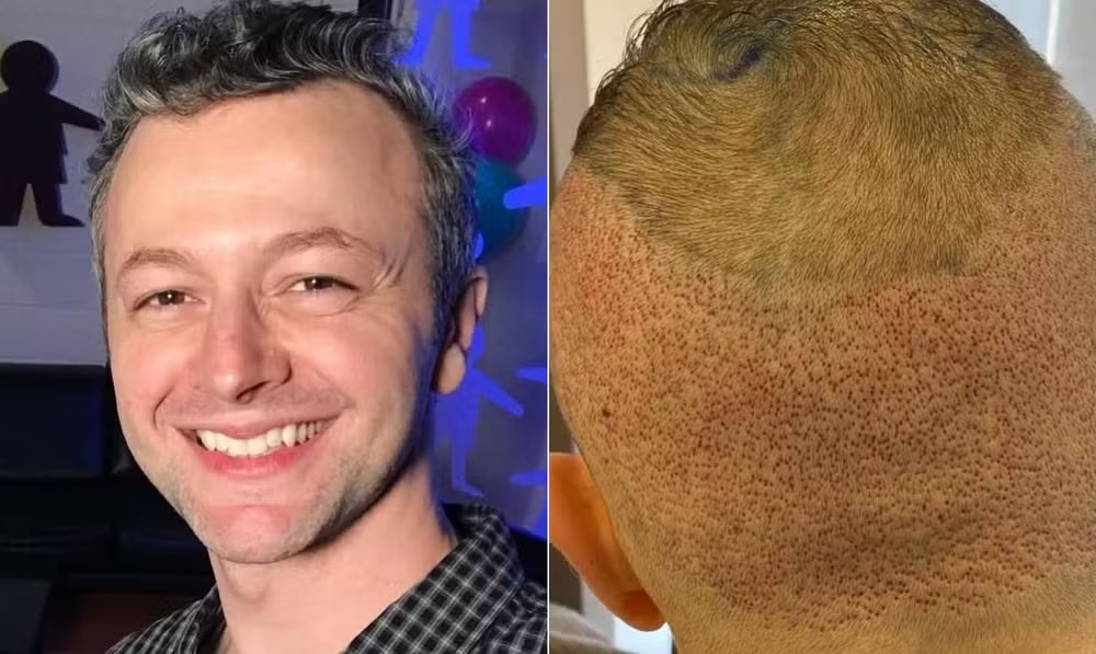 Lucas Lima antes e depois do procedimento de transplante capilar 