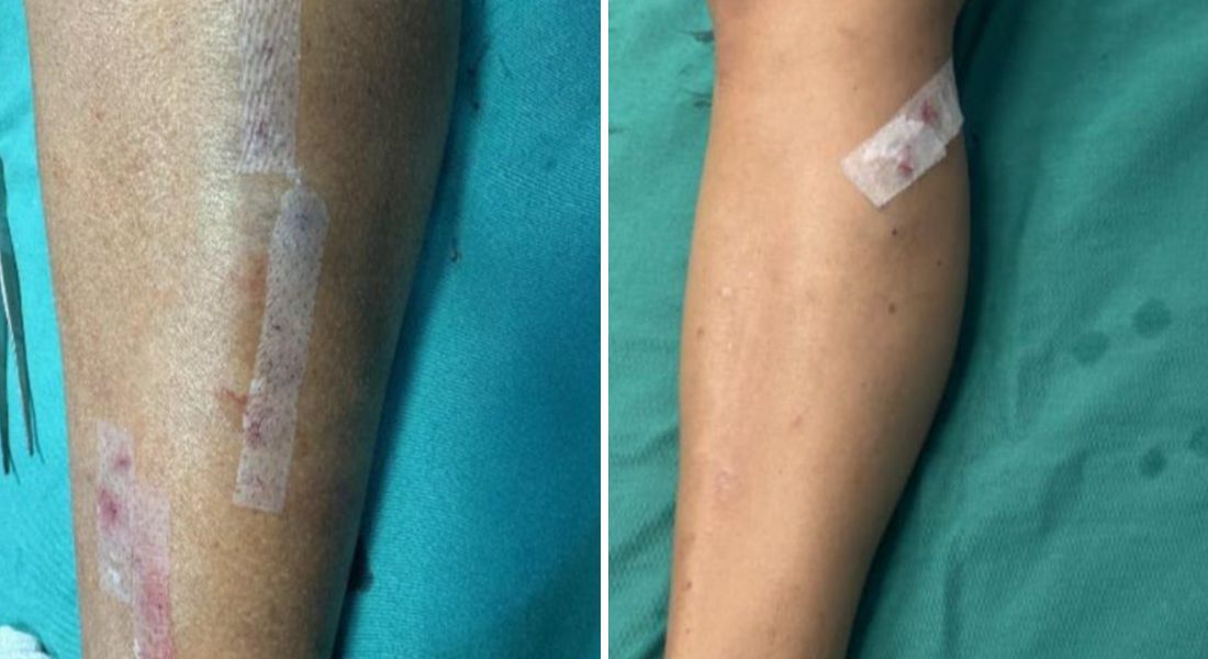 Curativo feito à base de cana-de-açúcar (à esq.) mostrou-se eficaz no comparativo com o material sintético (à dir.)